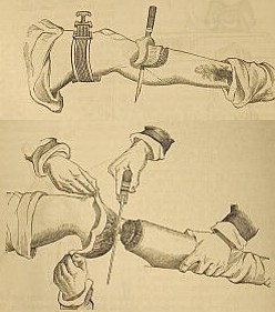 Illustration of Liston surgiccal knives.